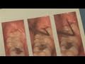 How To Alleviate Infected Wisdom Tooth