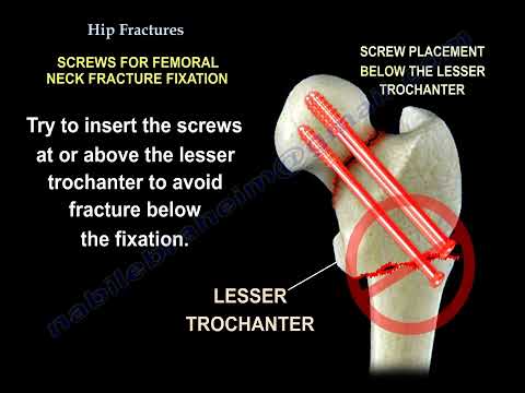 Femoral neck fracture fixation. hip fracture examination ,  x rays ,  treatment and surgery