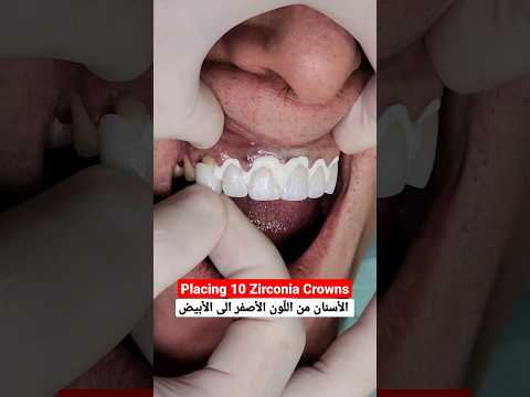 Placing Zirconia Crowns to hide all dark discolorations. #dentist #fyp