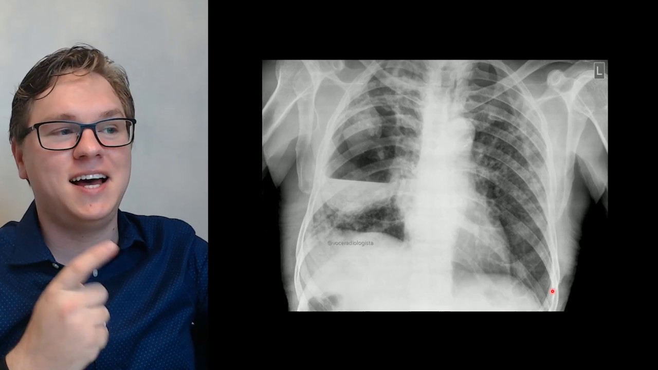 ABCESSO PULMONAR | DICA DO RADIO