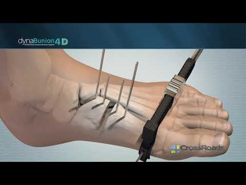 DynaBunion® 4D Minimal-Incision Lapidus System - Featuring Gen 2 Instruments