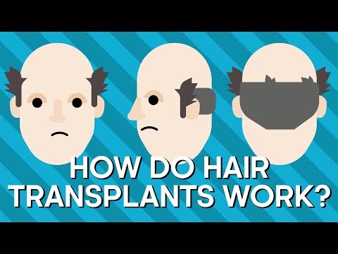 How Do Hair Transplants Work? | Earth Science