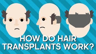 How Do Hair Transplants Work? | Earth Lab