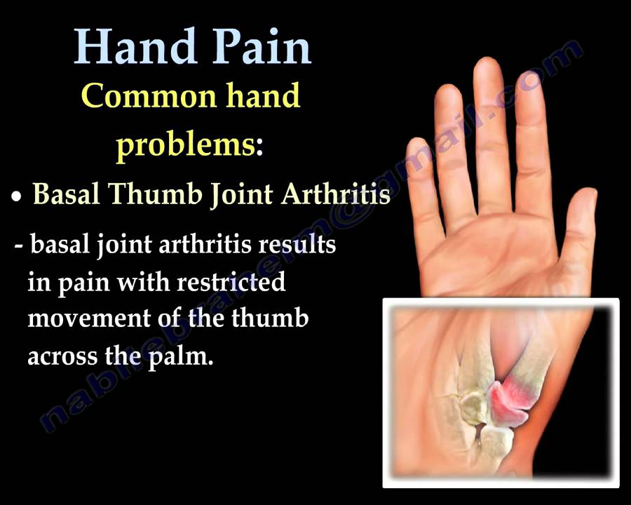 Say Goodbye to Hand Pain: Expert Tips from Dr. Nabil Ebraheim, Beauty Vigour