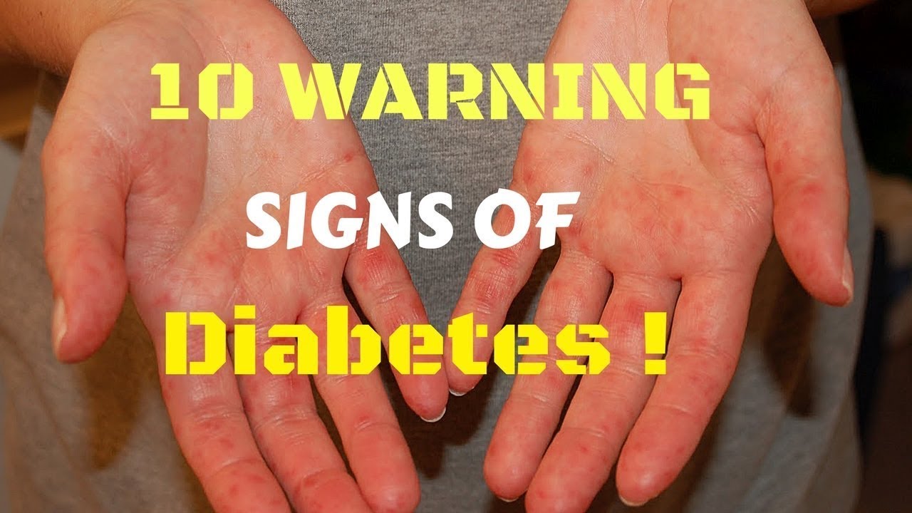 Diabetes Warning Signs, Live sa Bicol - ni Doc Willie Ong #433