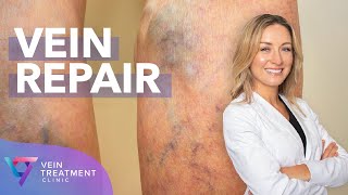 Medical Center: Vein Repair | Spider and Varicose Vein Treatment Center