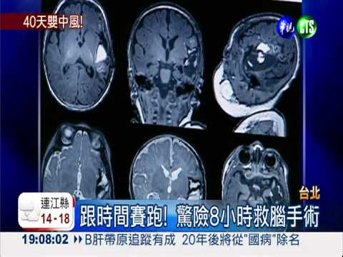出生40天! 男嬰血管瘤致腦中風