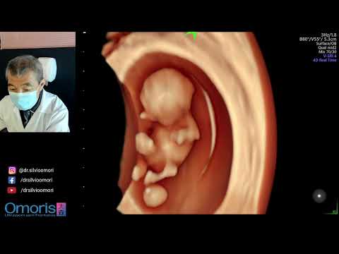 Pregnancy 9 weeks. 3D/4D ultrasound