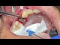Tooth extraction using straight elevator