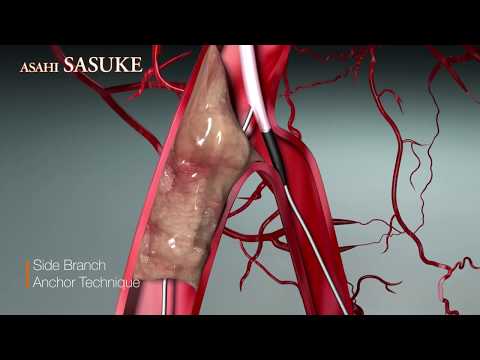 Side Branch Anchor Technique