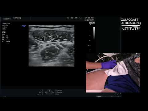How to Perform an Ultrasound Guided Fascia Iliaca Plane Block
