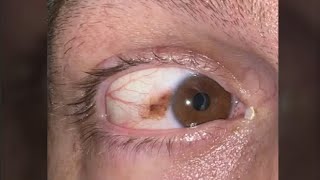 Brown Spot on Eye to Sparkling White: Gulani SPARKLE Procedure