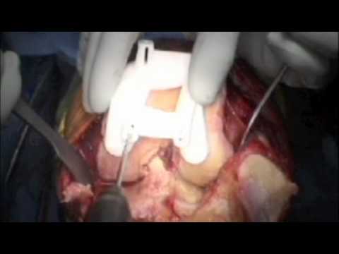 Total Knee Replacement Surgery using Patient Specific Implants - Part 1: Femoral