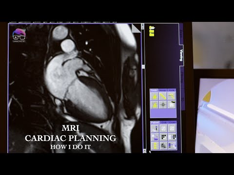 MRI CARDIAC PLANNING, HOW I DO IT