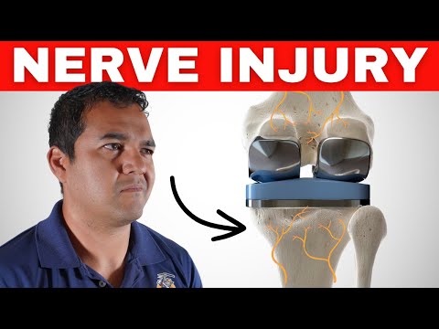 Most Common Type Of Nerve Injury After Knee Replacement Surgery