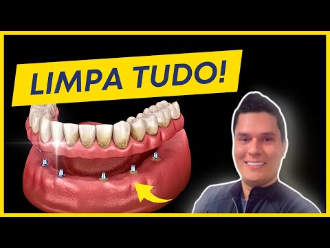 HOW TO CLEAN YOUR DENTAL IMPLANT? (COMPLETE GUIDE)!