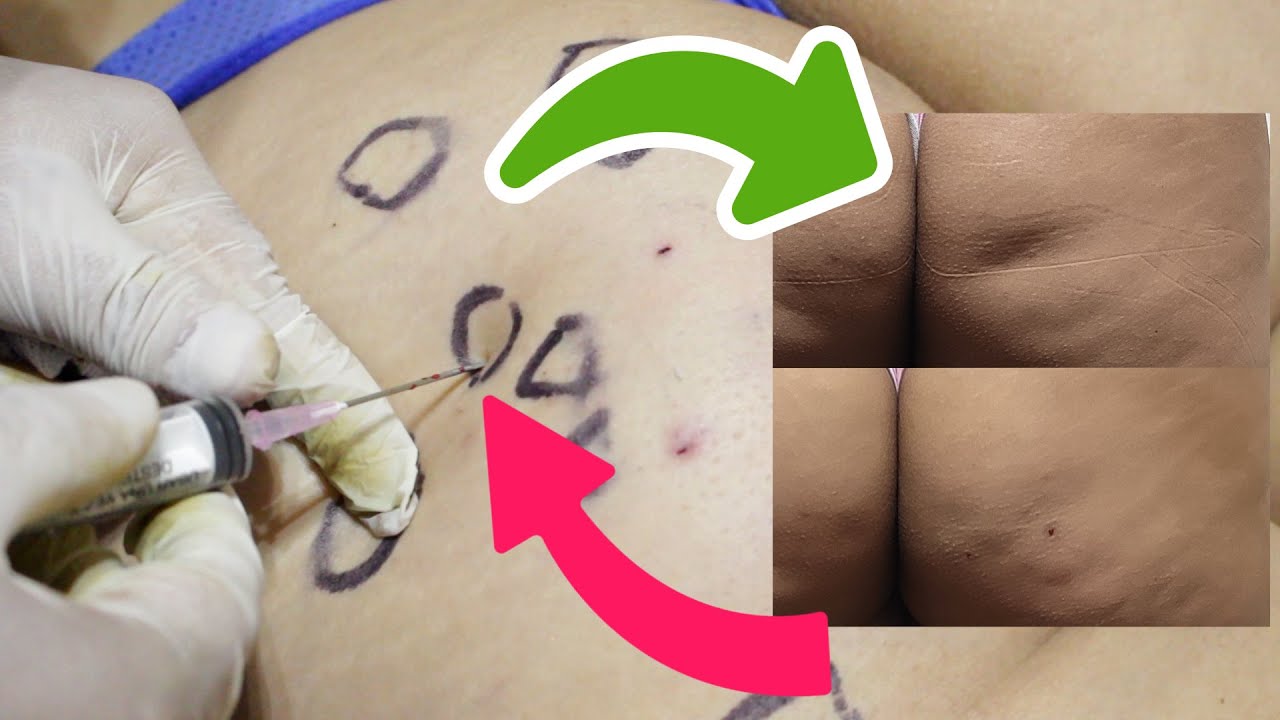 Eliminar PIEL DE NARANJA CELULITIS SEVERA 🔥 con SUBCISION es posible MEJOR TRATAMIENTO 2021 + CURSO
