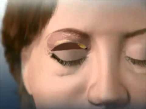 NYC Eyelid Surgery Animation - How the surgery is performed