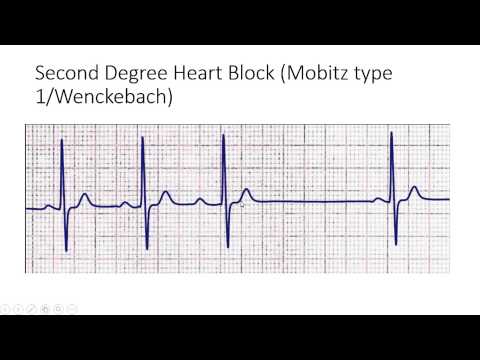 Second Degree Heart Block (Mobitz type 1/Wenckebach)