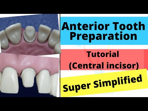 Anterior Crown Preparation - Demonstration (Super Easy)