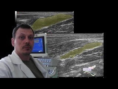 Pediatric Soft tissue ultrasound - Bilateral popliteal cysts with legs