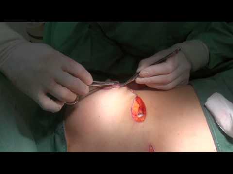 閲覧注意！乳房縮小手術（マンマリダクション）　大きすぎる垂れたバストを小さくする⑩：MikiTube-症例紹介：美容外科 高須クリニック