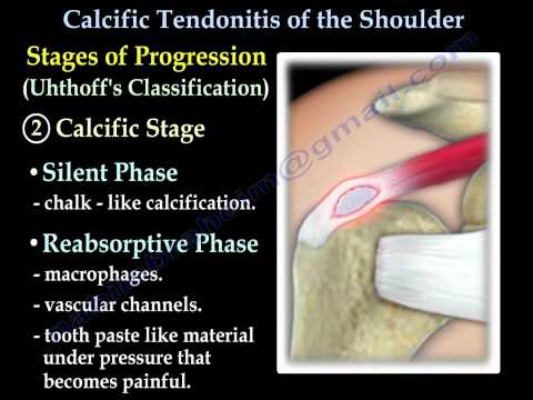 Calcific Tendonitis - Everything You Need To Know - Dr. Nabil Ebraheim
