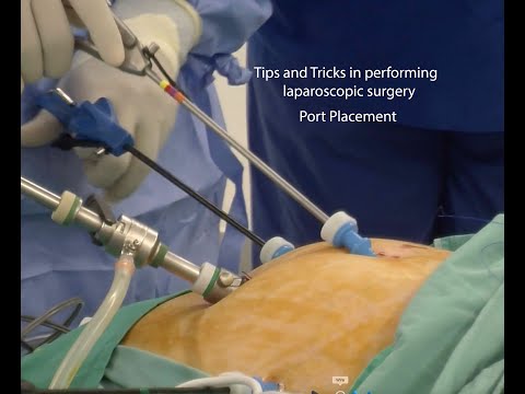 Consejos y trucos para realizar una cirugía laparoscópica - colocación del puerto
