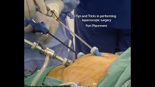 Tips and Tricks in performing laparoscopic surgery - Port placement