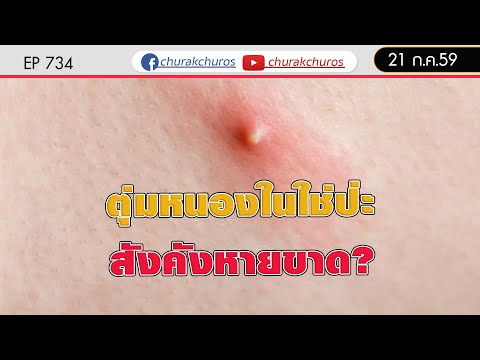 นิ้วอาการกลาก ผู้ที่อยู่ในกรุงมอสโกถือว่ากลาก
