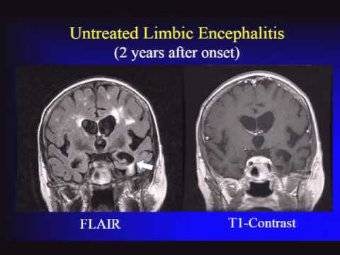 autoimmune encephalitis as cause of rapidly progressive dementia