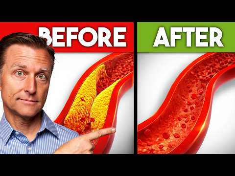 Best Nutrients to Remove Plaque from Arteries