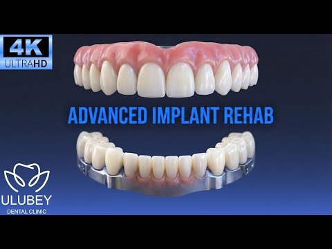 Prosthetic Rehabilitation on Long-Term Dental Implants | Uzun Süreli Dental İmplantlar