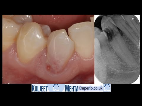 Internal Resorption & Dental Implant