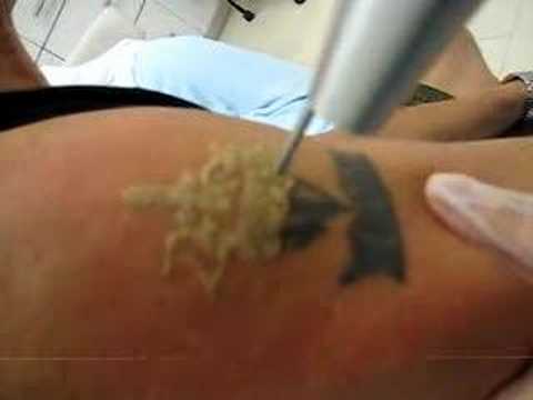 What does laser tattoo removal feel like? ? | Yahoo Answers