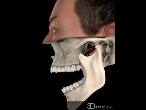 TMJ, with Reduction