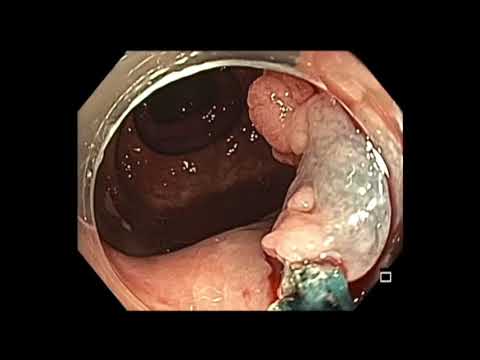 Colonoscopia - RME híbrida de pólipo rectal bajo
