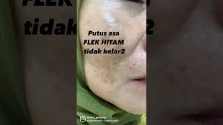 Download lagu Kenali jenis flek hitam kami sebelum memilih mau pakai perawatan yang mana mp3 Download lagu Kenali jenis flek hitam kami sebelum memilih mau pakai perawatan yang mana mp3