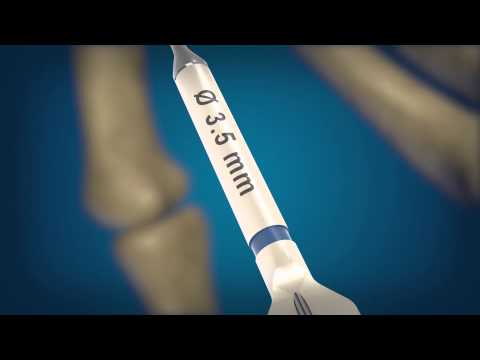 REDUCT Headless Compression Screw