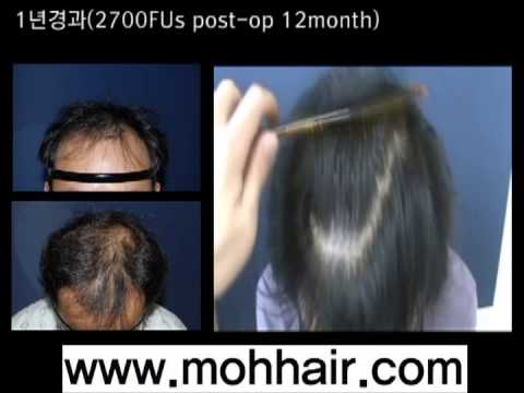 2700FU's. FUE Hair Transplantation by Dr. Moh