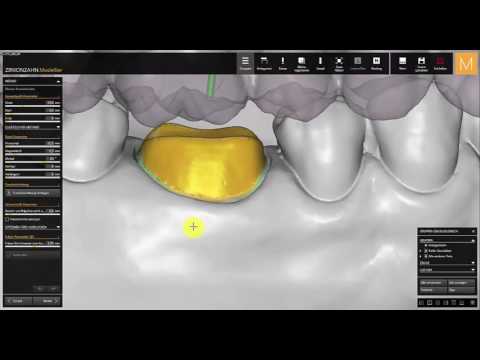 Vorschau ZZ exocad Einzelkappe