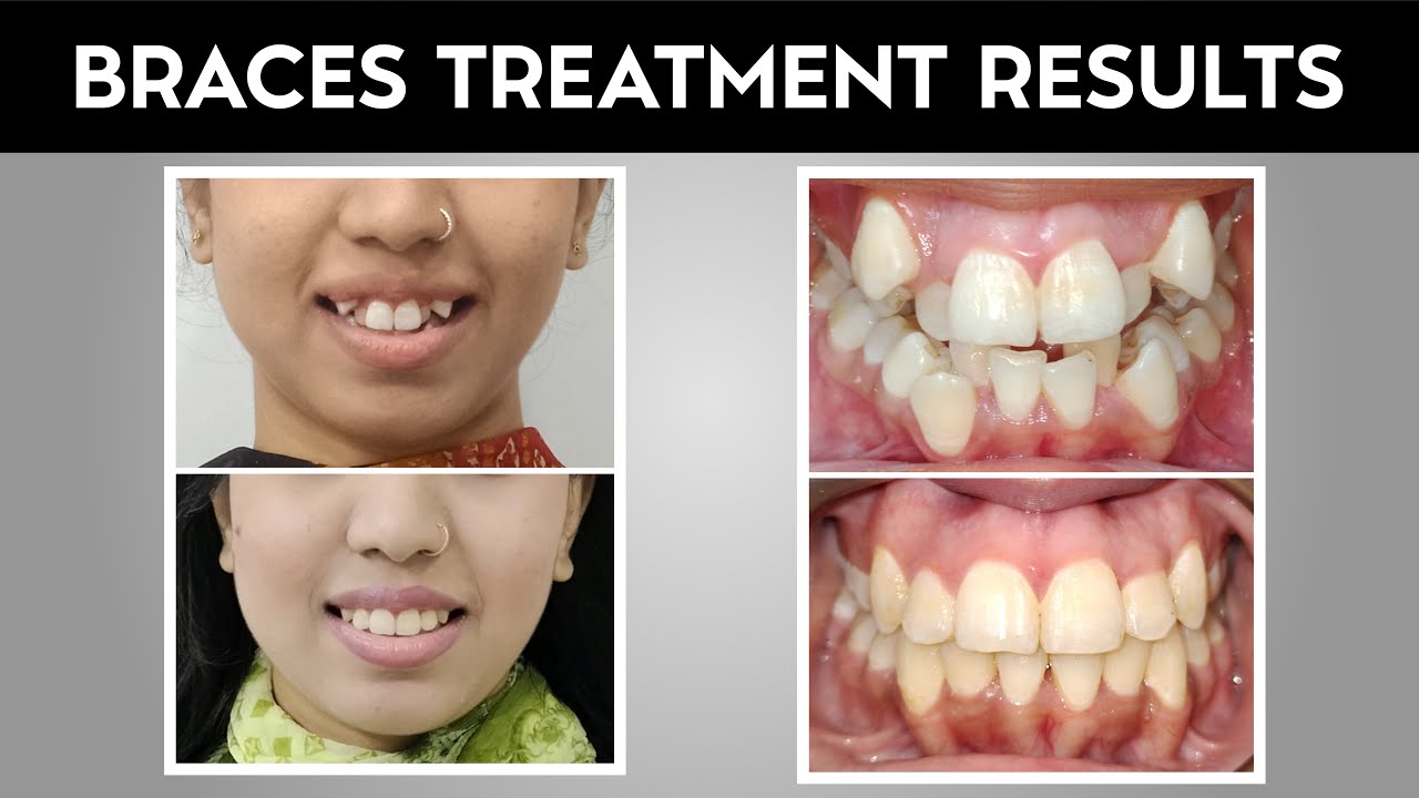 Teeth Braces Before And After Results | Best Dentist in Pakistan | Braces Journey | Dental Clinic