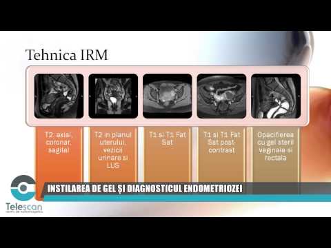 Telescan Endometrioza