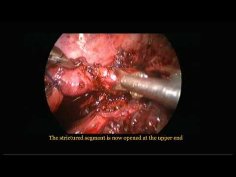 Thoracoscopic Resection of Post TEF Stricture Esophagus