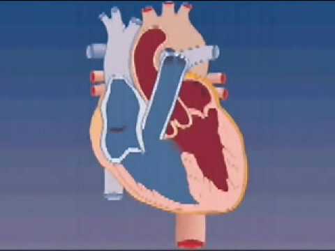 Tetralogy of Fallot