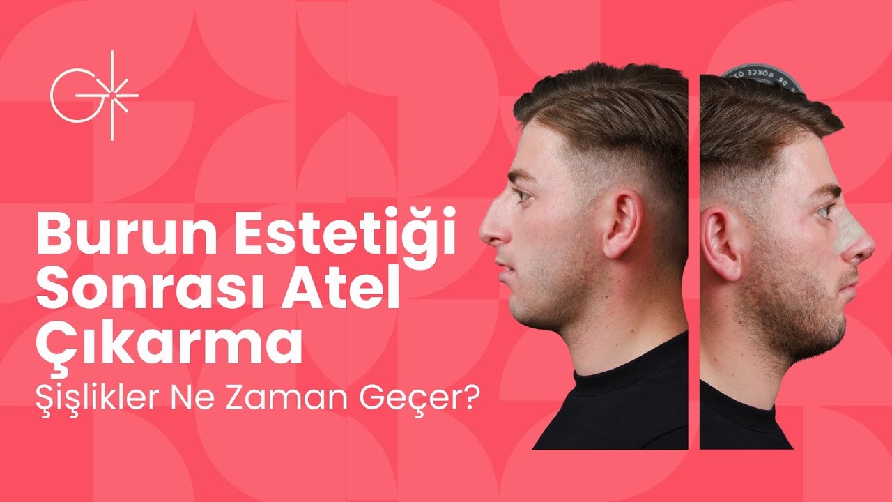 Burun Estetiği Sonrası Atel Çıkarma: Şişlikler Ne Zaman Geçer?