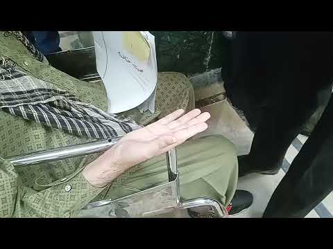 percussion Myotonia #myotonic #dystrophy #neurology #clinicalsigns #medicine