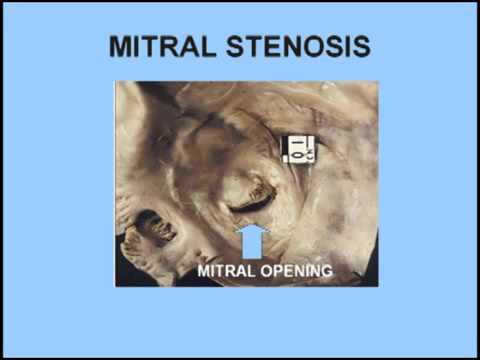 Heart Sounds Made Easy   Complete Guide for Beginners   Part 1  Basic Murmur