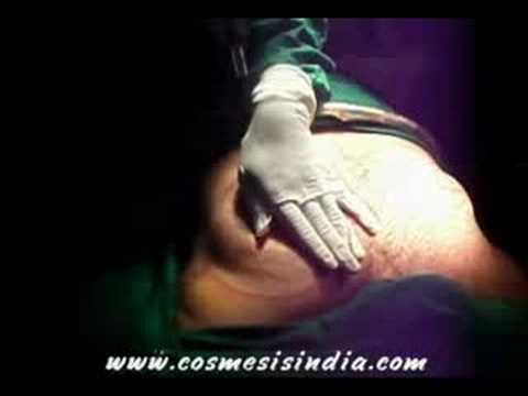 Male Breast Reduction or Man Boobs Surgery