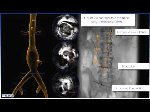Visions PV .035 Digital IVUS Catheter Animation